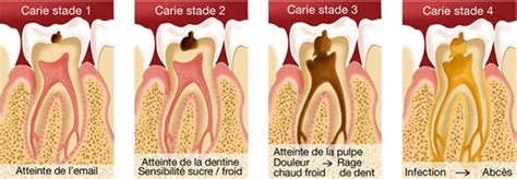 rage de dent en anglais|rage de dent traduction.